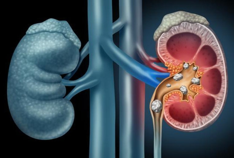Medical breakthrough eliminates kidney stones with little to no pain, study finds